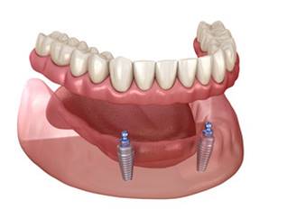 Mandibular removable prosthesis All on 2 system supported by implants with ball attachments. Medically accurate dental 3D illustration